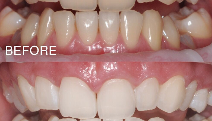 Whiteeeee teeth Whiteeeee teeth